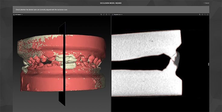 csm_Occlusion_osteotomies_735x370_04_881f821197